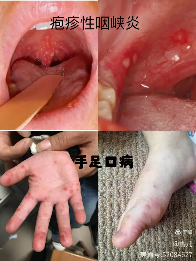 疱疹性咽峡炎是由肠道病毒引起的以急性发热和咽峡部疱疹溃疡为特征的